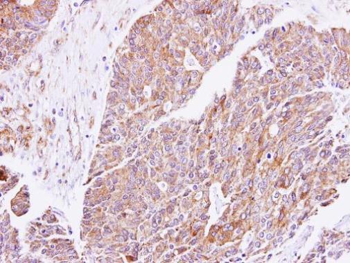 PRKG1 Antibody (OAGA01471) in Paraffin-embedded Endometrial CA using Immunohistochemistry