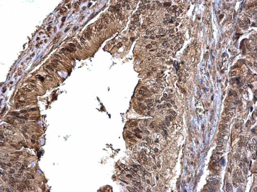 CDK6 Antibody (OAGA02236) in Human colon carcinoma using Immunohistochemistry