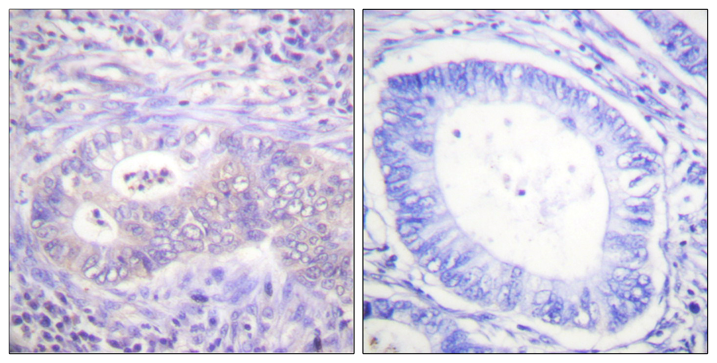 PFKFB2 Antibody (Phospho-Ser483) (OAAF07506) in Paraffin-embedded human colon carcinoma using Immunohistochemistry