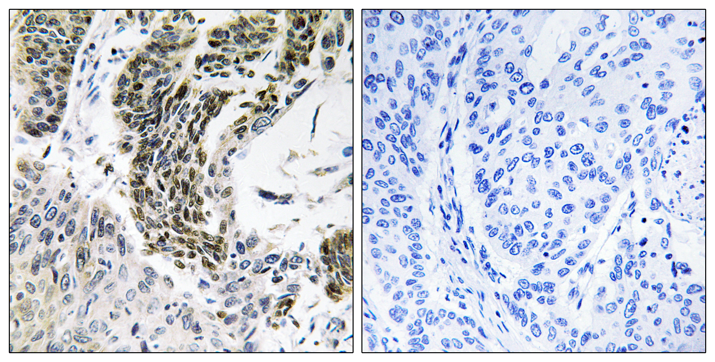 RREB1 Antibody (OAAF04161) in human lung carcinoma tissue using Immunohistochemistry.