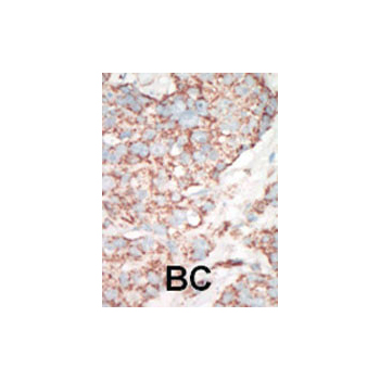 YSK antibody - C - terminal region (OAAB17342) in Human cancer, breast carcinoma, hepatocarcinoma using Immunohistochemistry