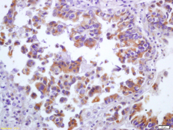 ALOX5 Antibody (OABF00182) in Human lung carcinoma using Immunohistochemistry