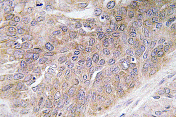 VEGF-D Antibody (OAAF06016) in human lung carcinoma tissue using Immunohistochemistry.