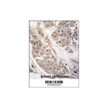 CTDSP2 antibody - N - terminal region (OAAB17631) in Human breast carcinoma using Immunohistochemistry