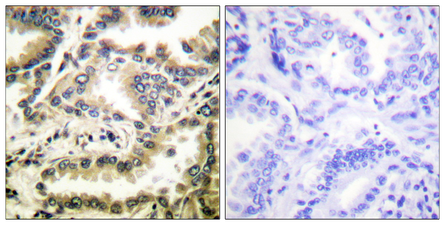 NF-kappaB p65 Antibody (Acetyl-Lys310) (OAAF08188) in Paraffin-embedded human lung carcinoma using Immunohistochemistry