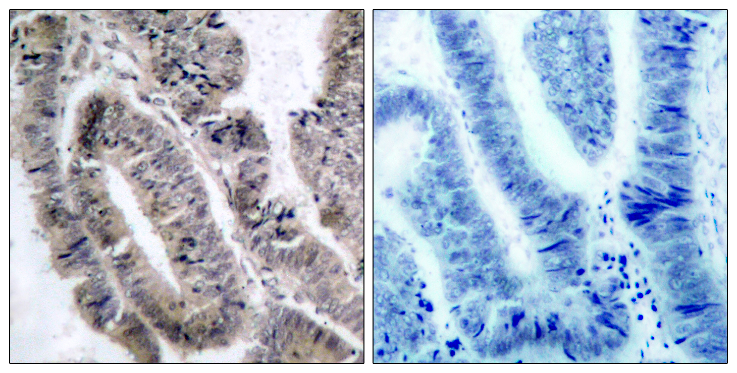 AMPK1 Antibody (Phospho-Ser496) (OAAF07671) in Paraffin-embedded human colon carcinoma using Immunohistochemistry