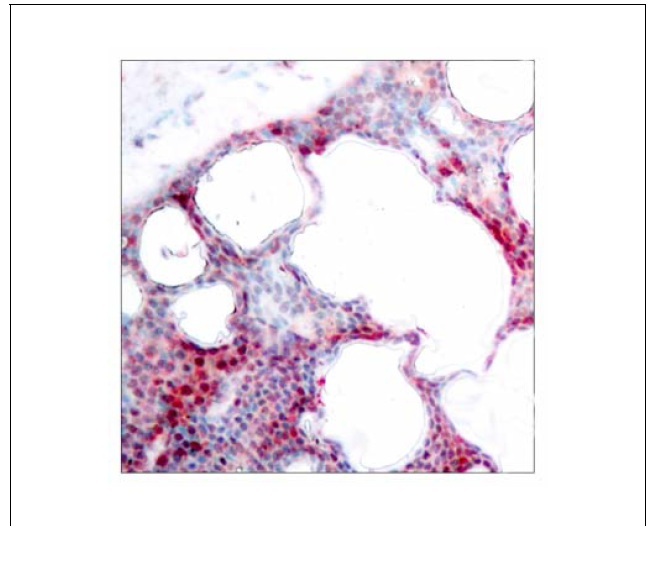 ATF-2 (Phospho-Ser62 or 44) Antibody (OAEC00029) in Human breast carcinoma using Immunohistochemistry