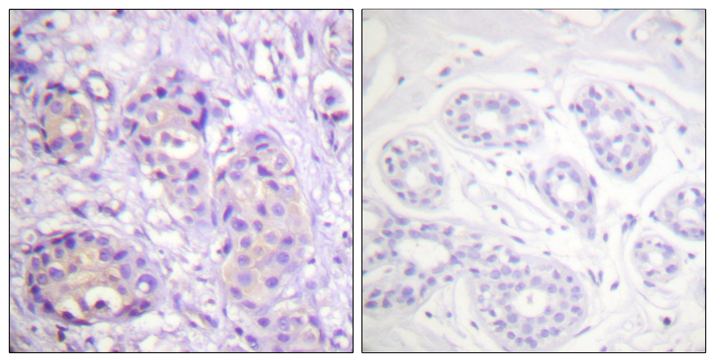 IKK-beta Antibody (Phospho-Tyr199) (OAAF07386) in Paraffin-embedded human breast carcinoma using Immunohistochemistry