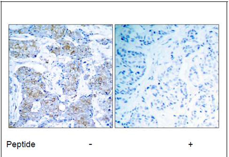 HER2 (Ab-1248) Antibody (OAEC00422) in Human breast carcinoma using Immunohistochemistry