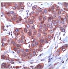 Rabbit Anti-14-3-3 zeta Polyclonal Antibody(OAAI00104) in Human Breast Cancer using Immunohistochemistry.