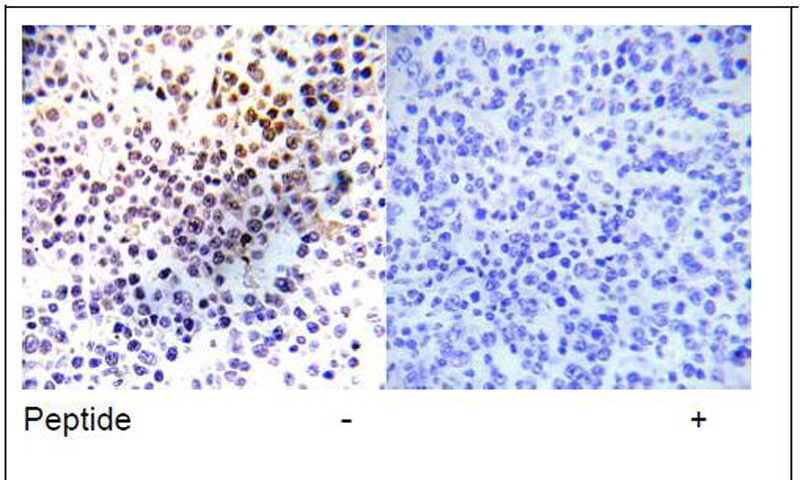 Histone H3.1 (Ab-28) Antibody (OAEC01426) in Human malignant lymphoma using Immunohistochemistry