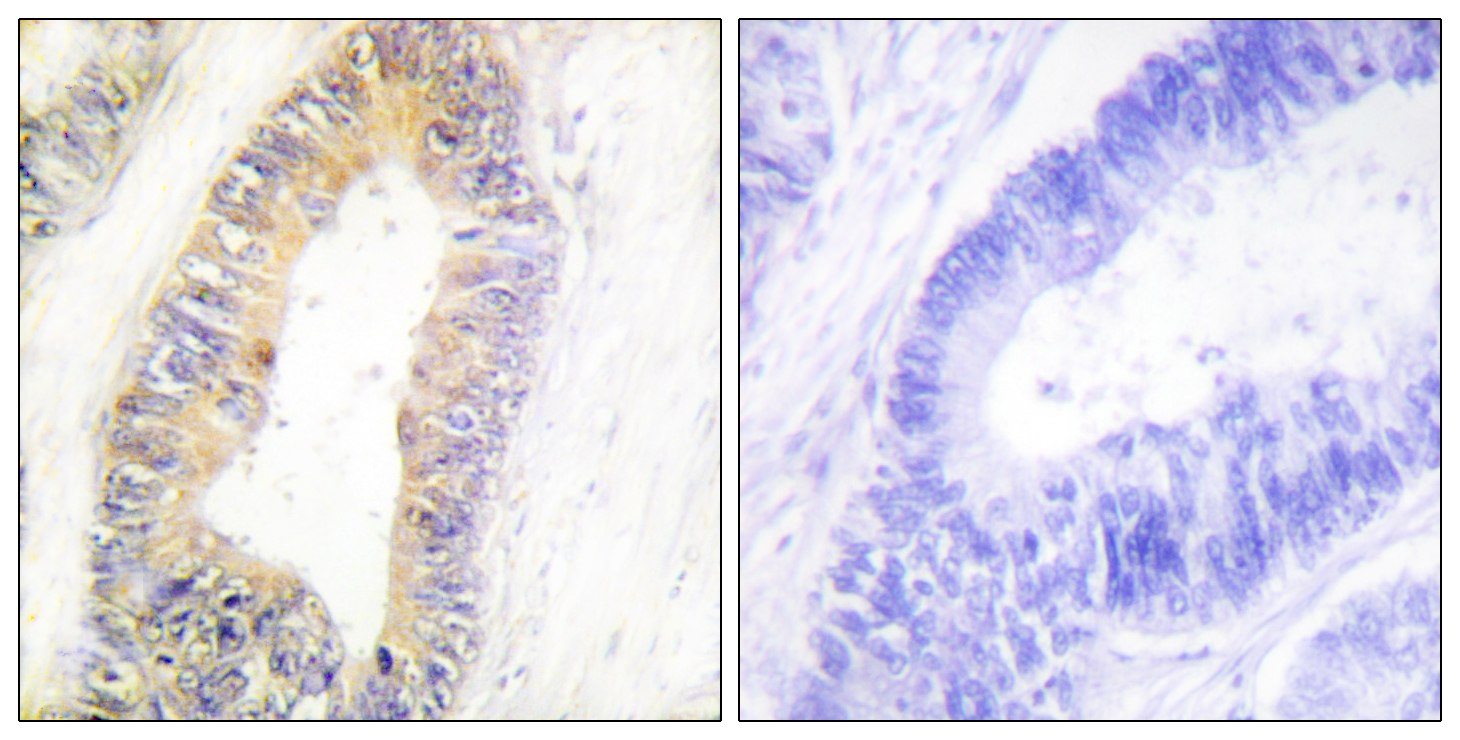 ZNF638 Antibody (OAAF02437) in human colon carcinoma tissue using Immunohistochemistry.