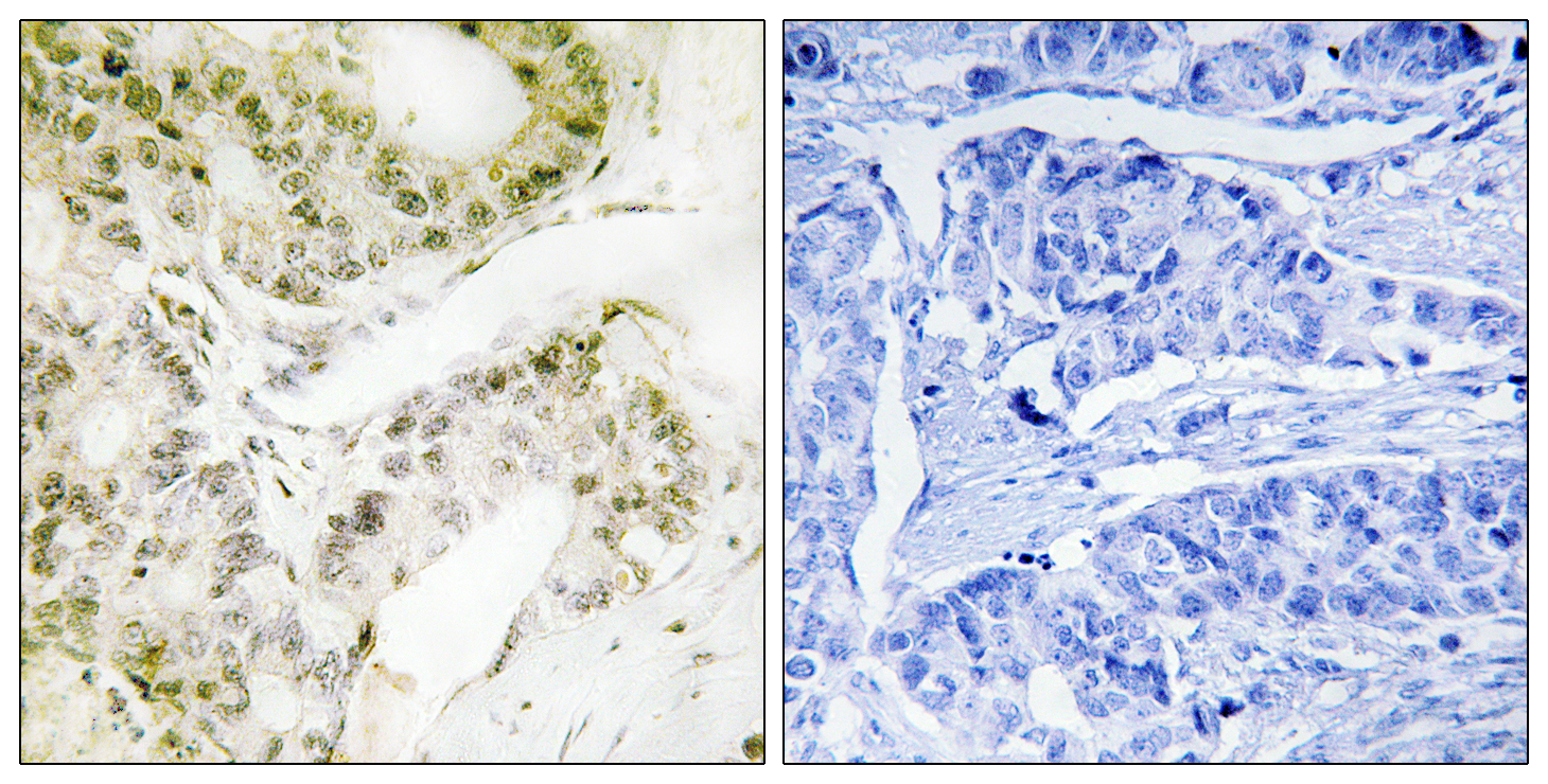 MED13 Antibody (OAAF02732) in human lung carcinoma using Immunohistochemistry.