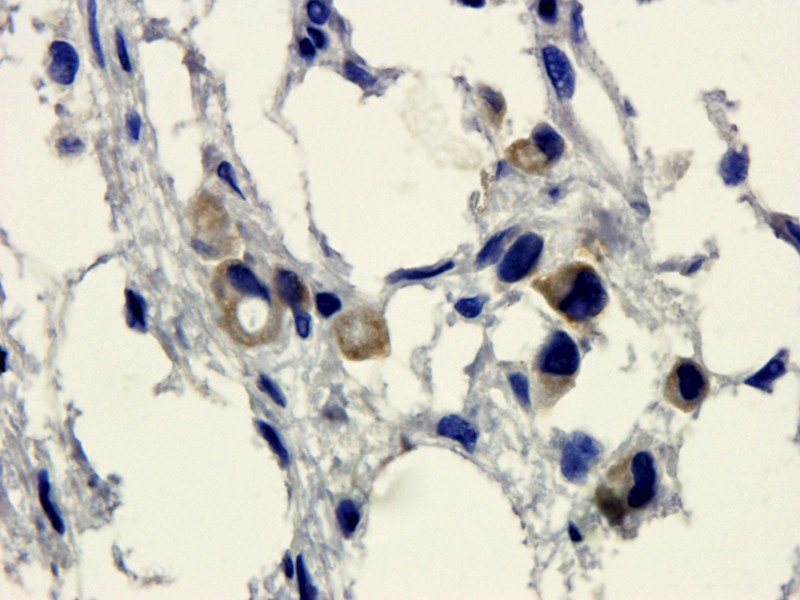 HE4 Antibody (OABI00004) in Human ovarian cancer tissue using Immunohistochemistry