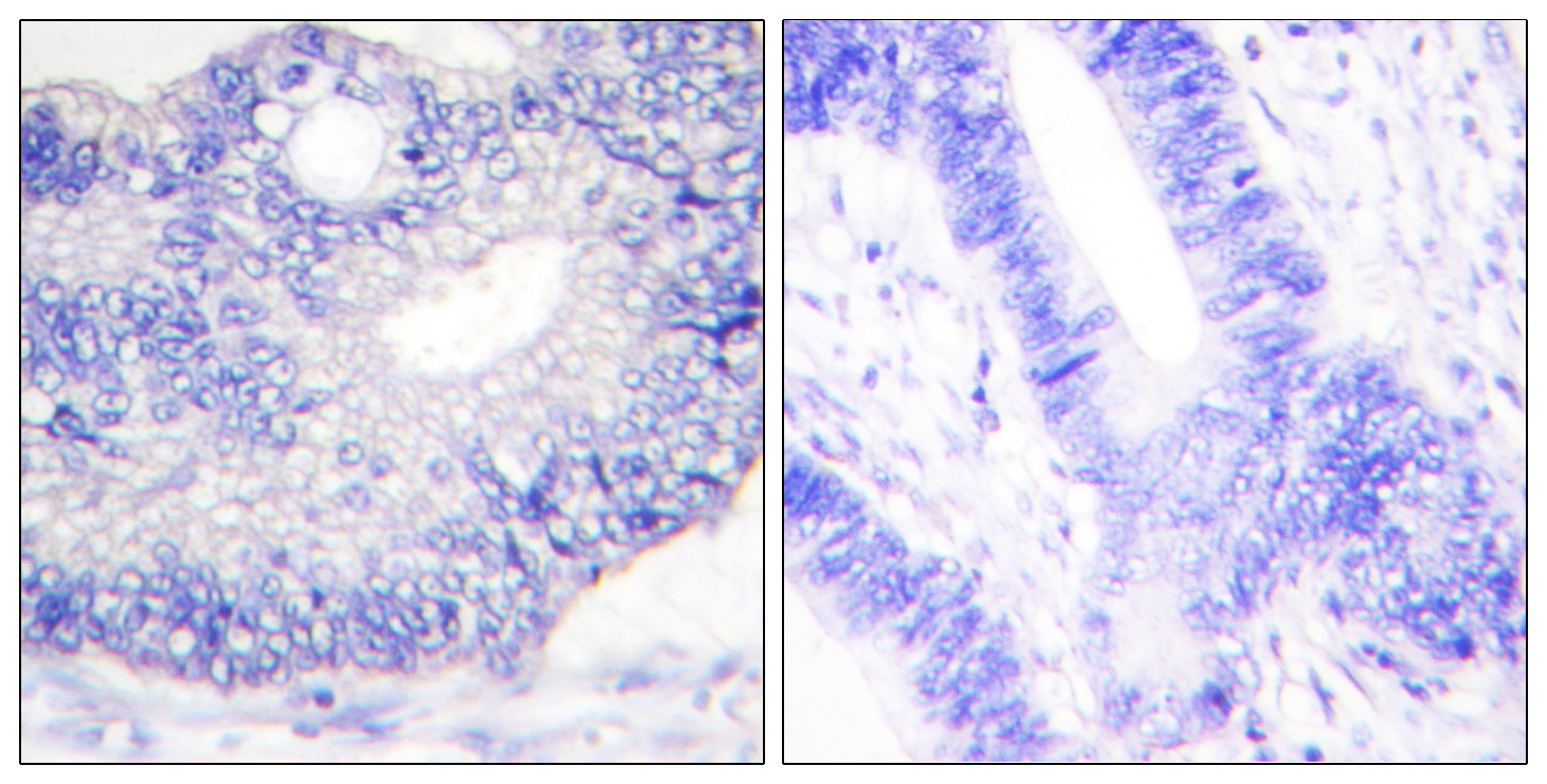 TGFA Antibody (OAAF01939) in human colon carcinoma tissue using Immunohistochemistry.