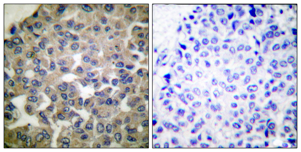 PLCG1 Antibody (OAAB18291) in Human breast carcinoma tissue using Immunohistochemistry