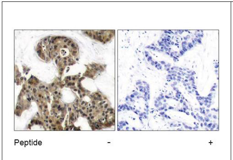 4E-BP1 (Ab-45) Antibody (OAEC00557) in Human breast carcinoma using Immunohistochemistry