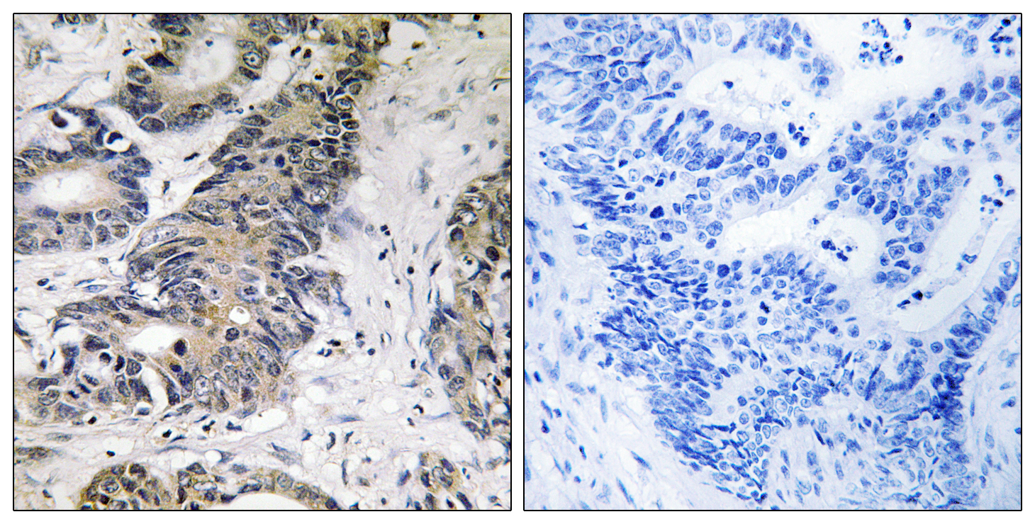 EIF4EBP1 Antibody (OAAF01604) in human colon carcinoma using Immunohistochemistry.