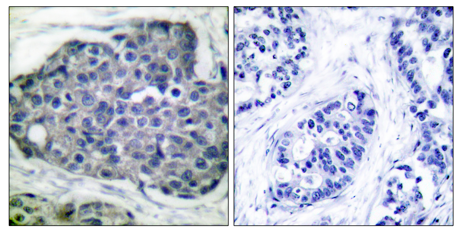 ACACA Antibody (Phospho-Ser80) (OAAF00033) in human breast carcinoma using Immunohistochemistry.