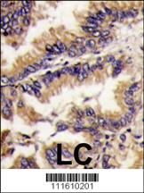 MAPK1 Antibody (Center) (OAAB17033) in human lung carcinoma tissue using immunohistochemistry
