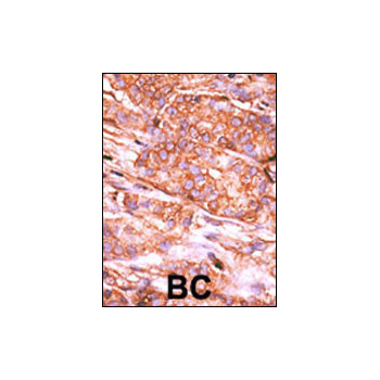 CTDSP2 antibody - N - terminal region (OAAB17631) in Human cancer, breast carcinoma, hepatocarcinoma using Immunohistochemistry