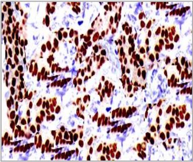 Rabbit Anti-Cyclin C Polyclonal Antibody(OAAI00305) in Human Breast carcinoma using Immunohistochemistry.