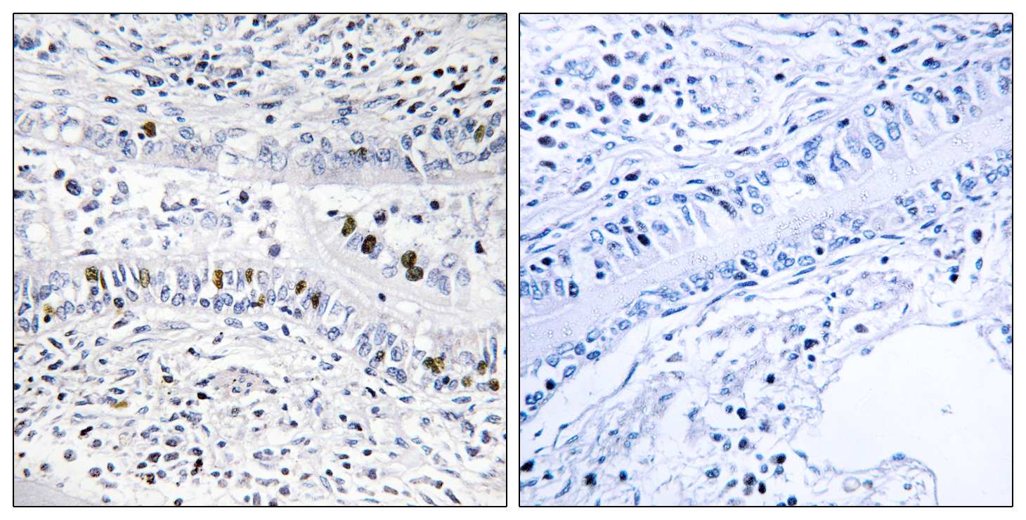 EZH1 Antibody (OAAF02587) in human lung carcinoma tissue using Immunohistochemistry.
