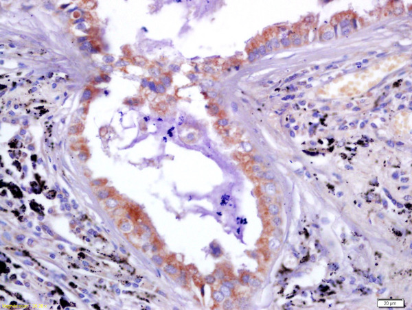 LAG3 Antibody (OABF01057) in Human lung carcinoma using Immunohistochemistry