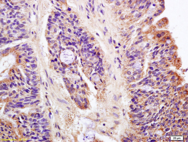 LAPTM4B Antibody (OABF01705) in Human colon carcinoma using Immunohistochemistry