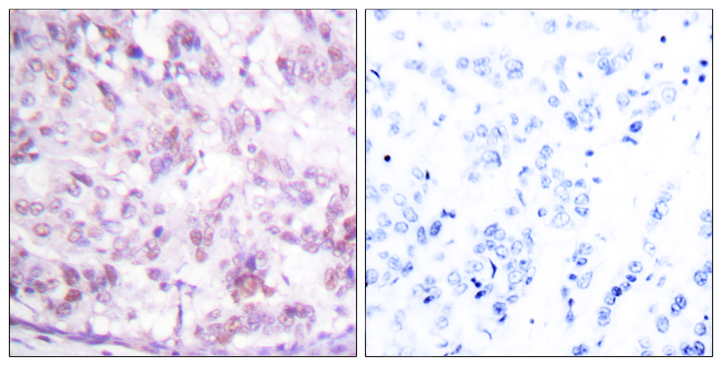 MYB Antibody (OAAF00793) in human breast carcinoma tissue using Immunohistochemistry.