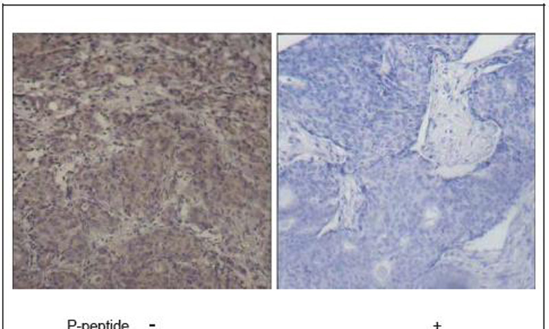 Smad3 (Phospho-Ser425) Antibody (OAEC00288) in Human breast carcinoma using Immunohistochemistry