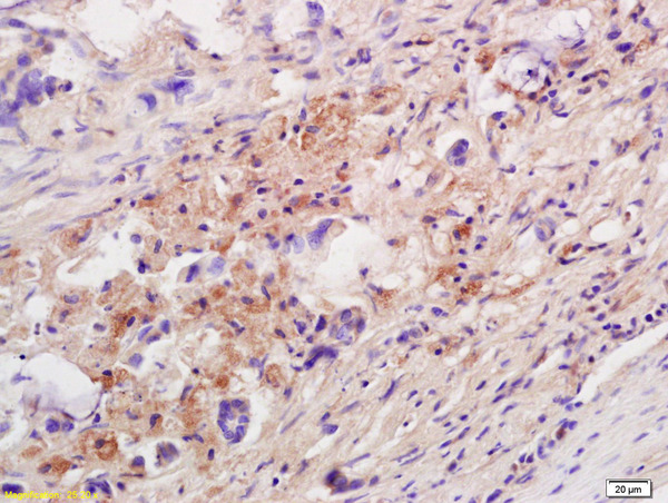 IL10 Antibody (OABF01747) in Human colon carcinoma using Immunohistochemistry
