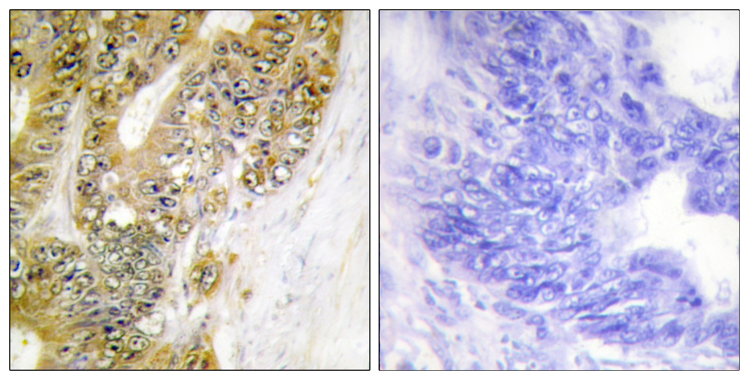 MDM2 Antibody (OAAF01177) in human colon carcinoma tissue using Immunohistochemistry.