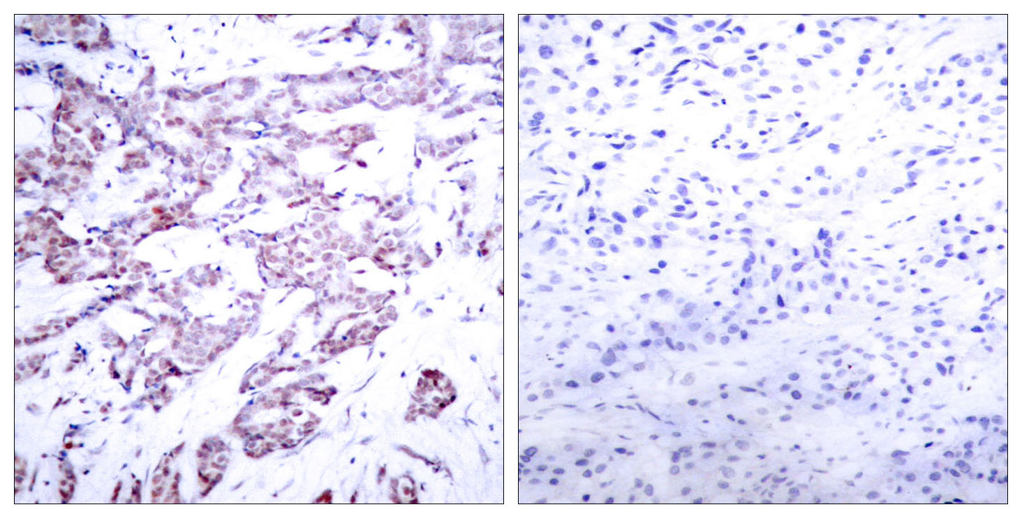 STAT6 Antibody (Phospho-Thr645) (OAAF07788) in Paraffin-embedded human breast carcinoma using Immunohistochemistry
