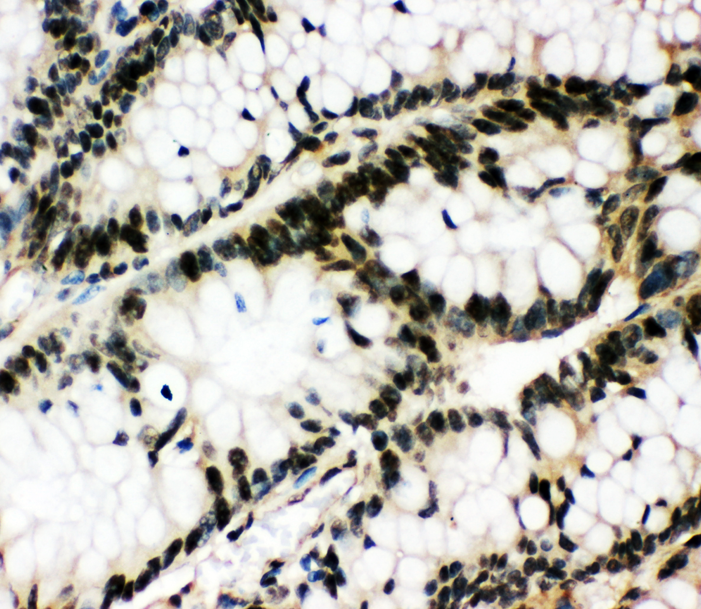 EGR1 Antibody - N-terminal region (OABB01340) in Human Intestinal Cancer Tissue using Immunohistochemistry