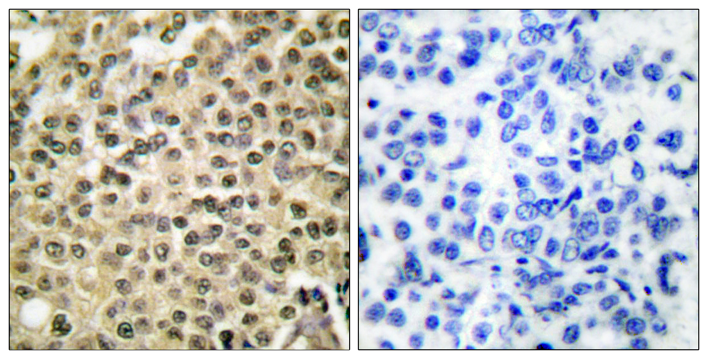 RAN Antibody (OAAF01912) in human breast carcinoma tissue using Immunohistochemistry.