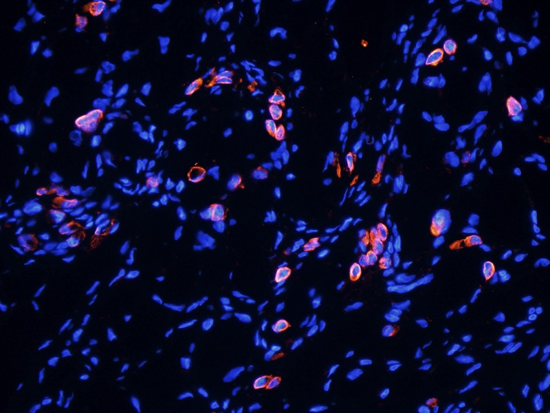 HE4 Antibody (OABI00004) in Human ovarian cancer tissue using Immunofluorescence