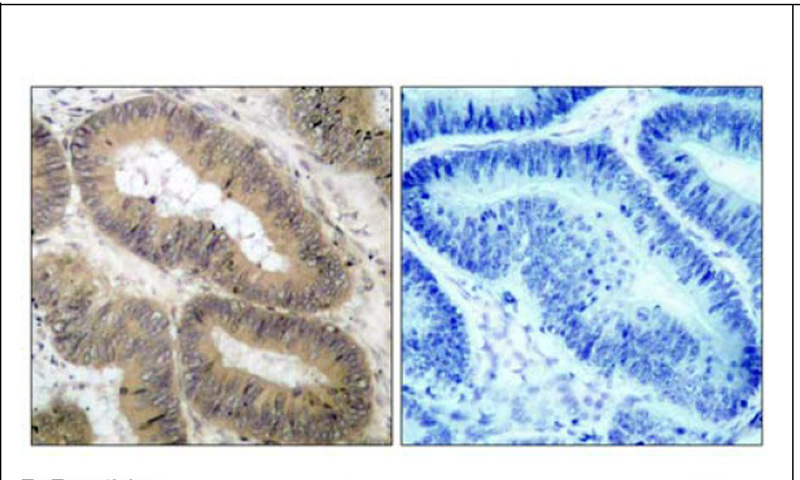 IKK (Phospho-Thr23) Antibody (OAEC00127) in Human colon carcinoma using Immunohistochemistry