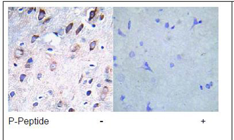 PDGF Receptor beta (Phospho-Tyr751) Antibody (OAEC00332) in Human breast carcinoma using Immunohistochemistry