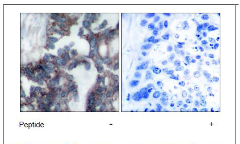 p70 S6 Kinase (Ab-424) Antibody (OAEC00611) in Human breast carcinoma using Immunohistochemistry