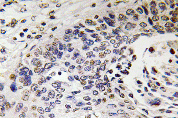 NF-H Antibody (OAAF05869) in human lung carcinoma tissue using Immunohistochemistry.