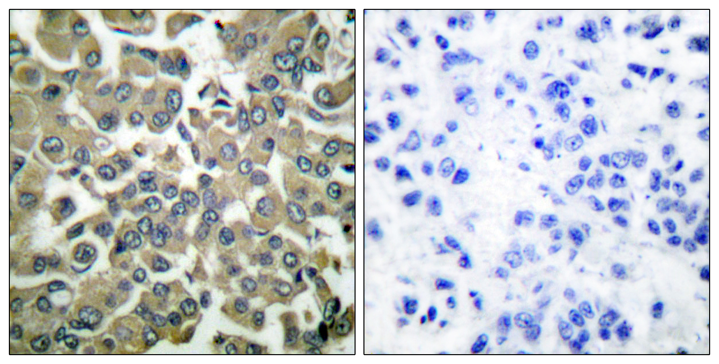 WNK1 Antibody (Phospho-Thr58) (OAAF07338) in Paraffin-embedded human breast carcinoma using Immunohistochemistry