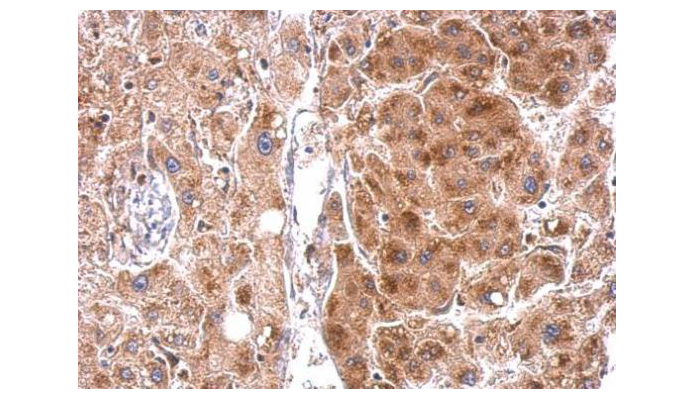 STAR antibody (OAGA00424) in hepatoma using Immunohistochemistry