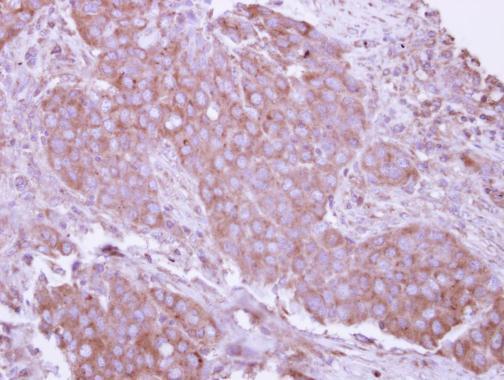 CD27 Antibody (OAGA02293) in Paraffin-embedded Breast ca using Immunohistochemistry