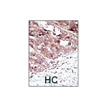 PHKG2 antibody - N - terminal region (OAAB17009) in Human cancer, breast carcinoma, hepatocarcinoma using Immunohistochemistry