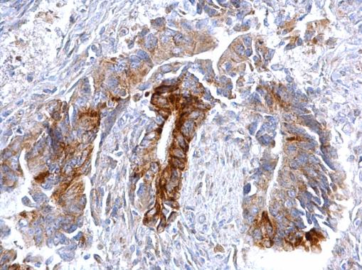 CCR3 Antibody - C-terminal region (OAGA01253) in Human colon carcinoma using Immunohistochemistry