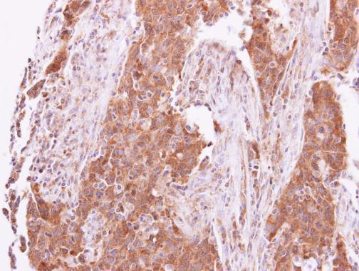 TNK2 Antibody - N-terminal region (OAGA02687) in Paraffin-embedded Lung papillory adenocarcinoma using Immunohistochemistry