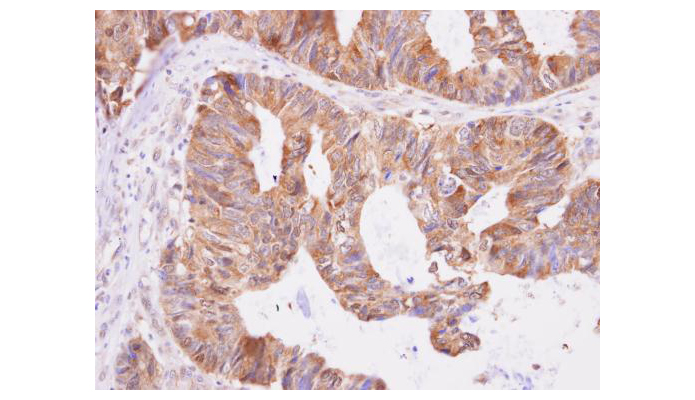 DNPEP antibody (OAGA00147) in colon carcinoma using Immunohistochemistry
