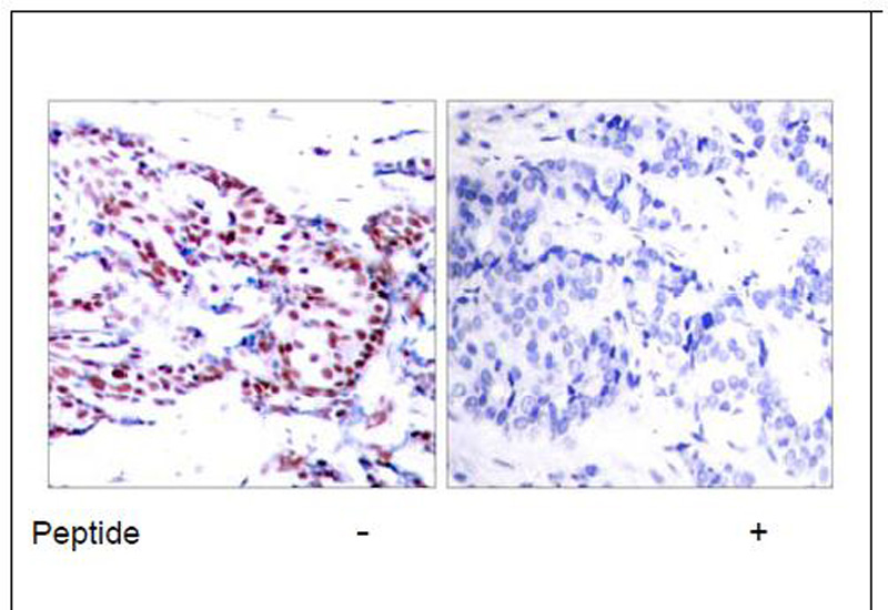 ATF-2 (Ab-71 or 53) Antibody (OAEC00381) in Human breast carcinoma using Immunohistochemistry