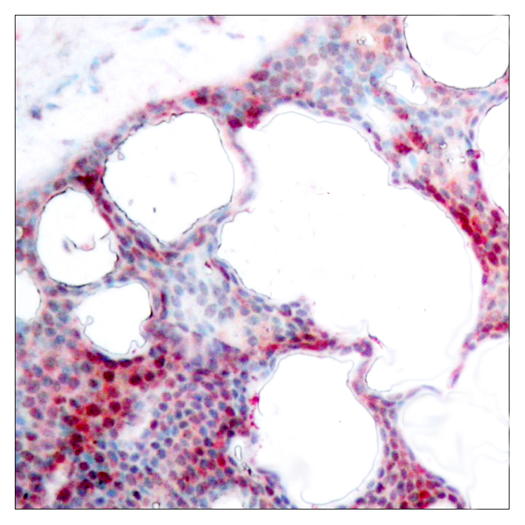 ATF2 Antibody (Phospho-Ser62 or 44) (OAAF07677) in Paraffin-embedded human breast carcinoma using Immunohistochemistry